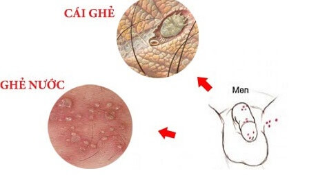 Ghẻ sinh dục